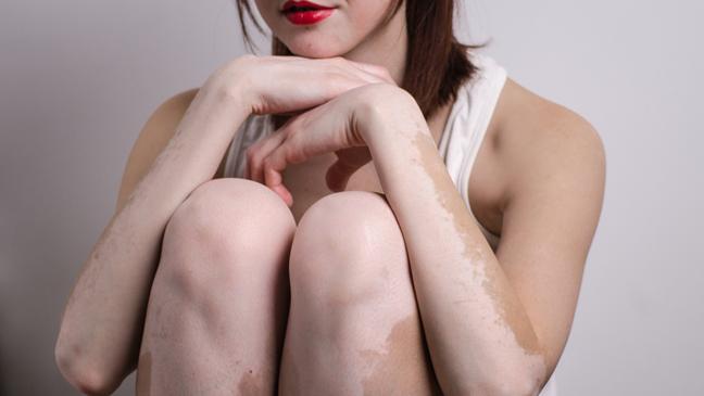 could-you-have-vitiligo-the-symptoms-the-sufferers-and-the-causes-136398861908003901-150624160838